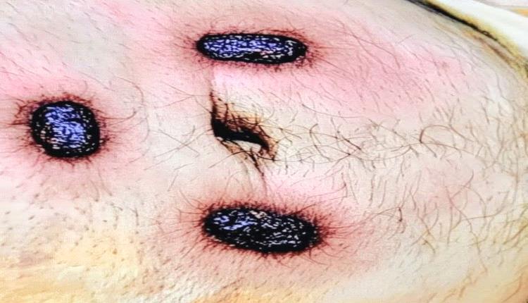 شاب يكتشف سبب ألمه المزمن بعد سنوات من المعاناة.. تشخيص نادر في صنعاء