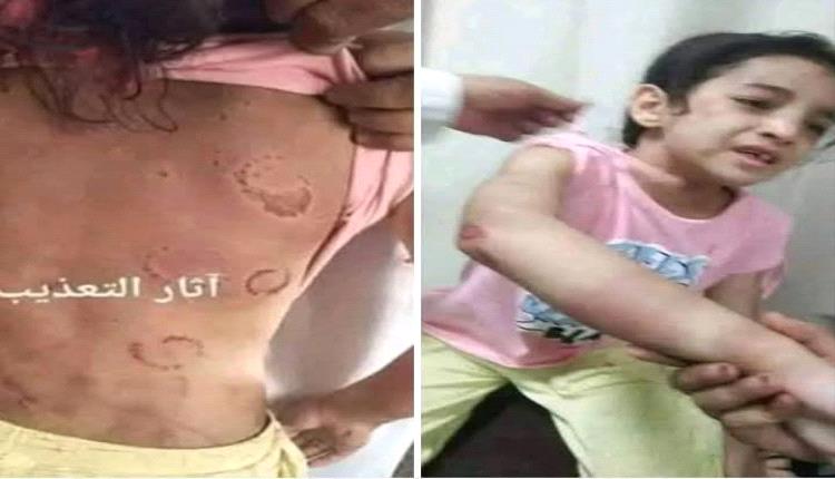زوجة أب تعذب طفلة حتى كسر أضلاعها بسبب تنظيف المطبخ